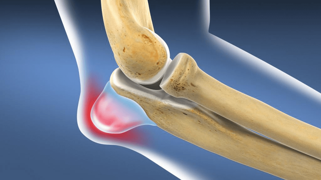 Bursitis and joint swelling