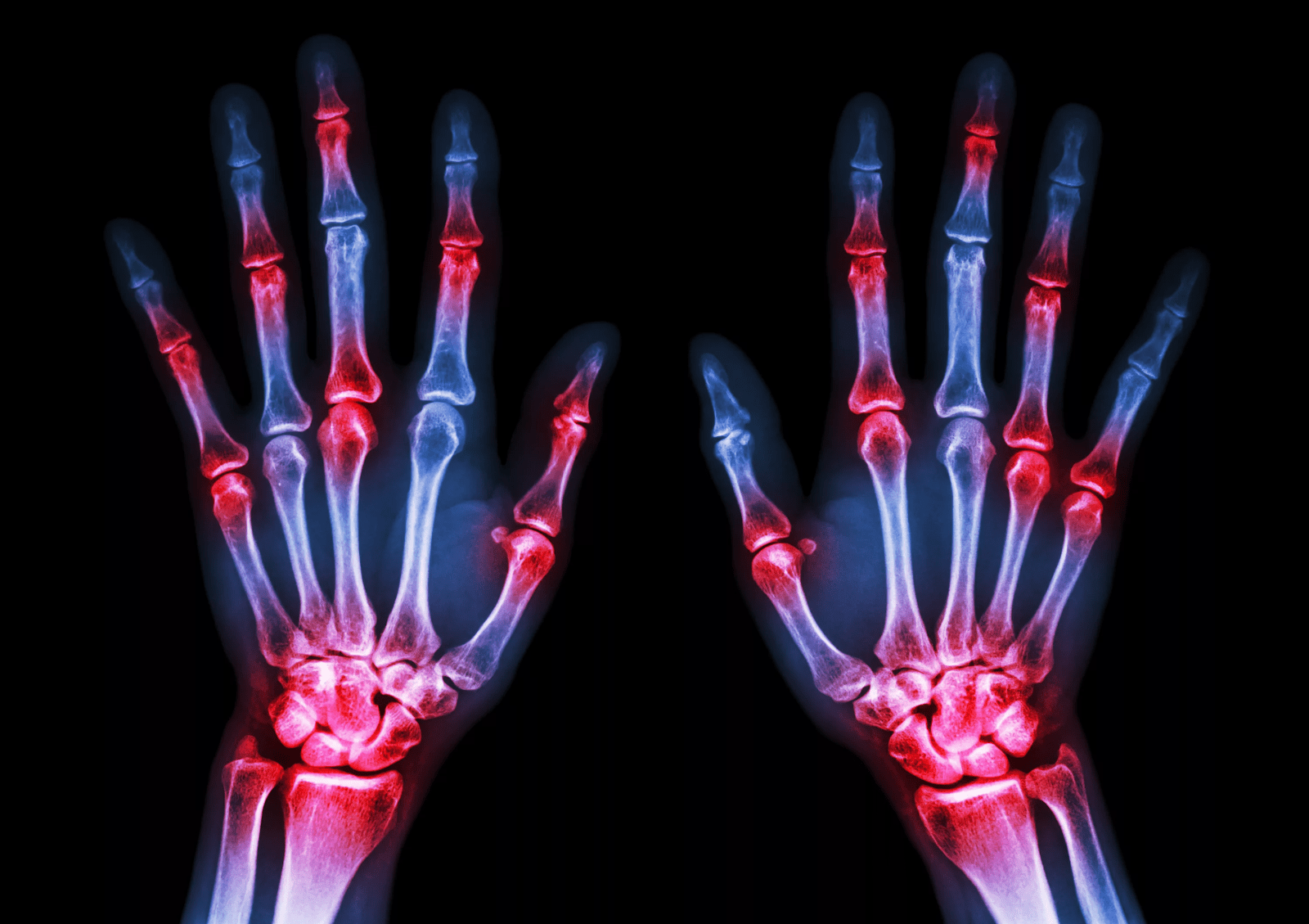 Rheumatoid arthritis affecting the joints